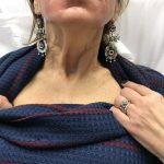 2 weeks before botox in platysmal bands of neck