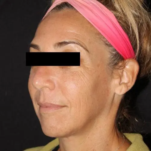 Facials & Peels Before and After - Case 2, Image 1 - Female, age 45 – 54 - Baltimore, MD - Skin Therapeutics Med Spa