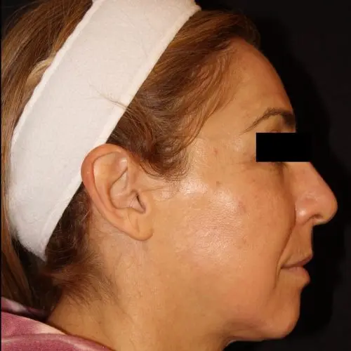 Facials & Peels Before and After - Case 2, Image 6 - Female, age 45 – 54 - Baltimore, MD - Skin Therapeutics Med Spa