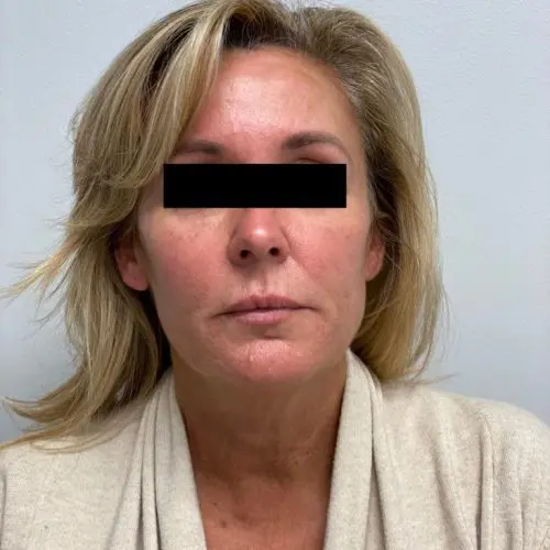 Silhouette InstaLift Before and After - Case -1, Image 2 - Female, age 45 – 54 - Baltimore, MD - Skin Therapeutics Med Spa