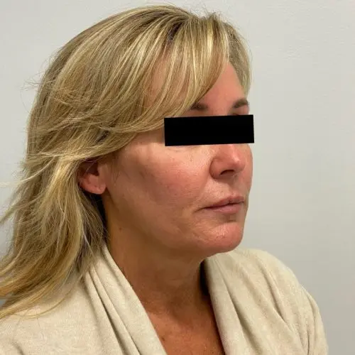 Silhouette InstaLift Before and After - Case -1, Image 4 - Female, age 45 – 54 - Baltimore, MD - Skin Therapeutics Med Spa