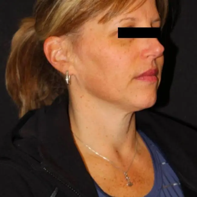 Facials & Peels Before and After - Case -1, Image 2 - Female, age 35 – 44 - Baltimore, MD - Skin Therapeutics Med Spa