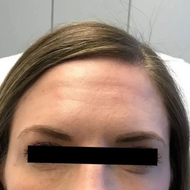 Botox Before and After - Case -1, Image 2 - Female, age 45 – 54 - Baltimore, MD - Skin Therapeutics Med Spa