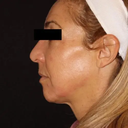 Facials & Peels Before and After - Case 2, Image 4 - Female, age 45 – 54 - Baltimore, MD - Skin Therapeutics Med Spa