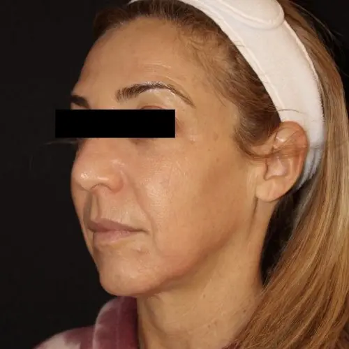 Facials & Peels Before and After - Case 2, Image 2 - Female, age 45 – 54 - Baltimore, MD - Skin Therapeutics Med Spa