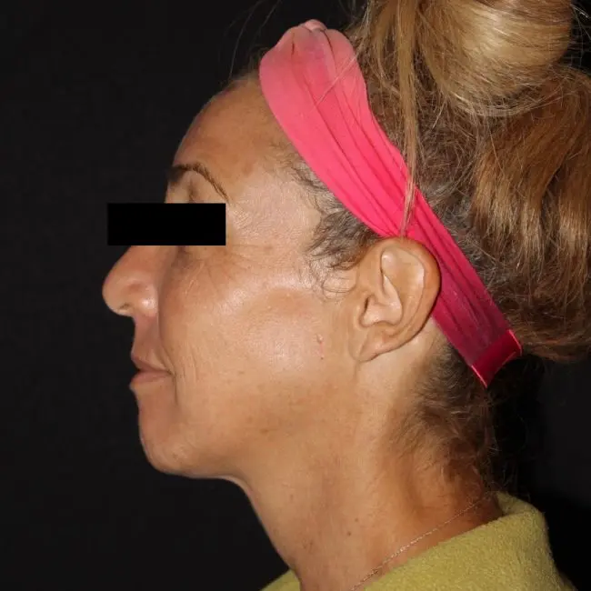 Facials & Peels Before and After - Case 2, Image 3 - Female, age 45 – 54 - Baltimore, MD - Skin Therapeutics Med Spa