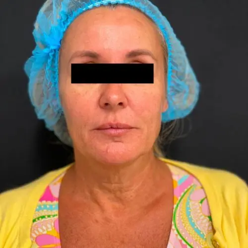 Silhouette InstaLift Before and After - Case -1, Image 1 - Female, age 45 – 54 - Baltimore, MD - Skin Therapeutics Med Spa