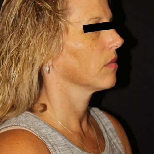 Facials & Peels Before and After - Case -1, Image 1 - Female, age 35 – 44 - Baltimore, MD - Skin Therapeutics Med Spa