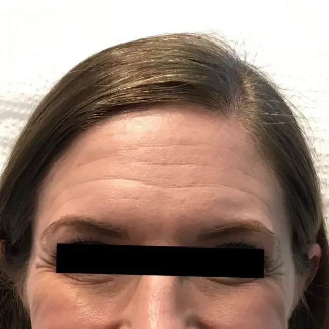 Botox Before and After - Case -1, Image 1 - Female, age 45 – 54 - Baltimore, MD - Skin Therapeutics Med Spa