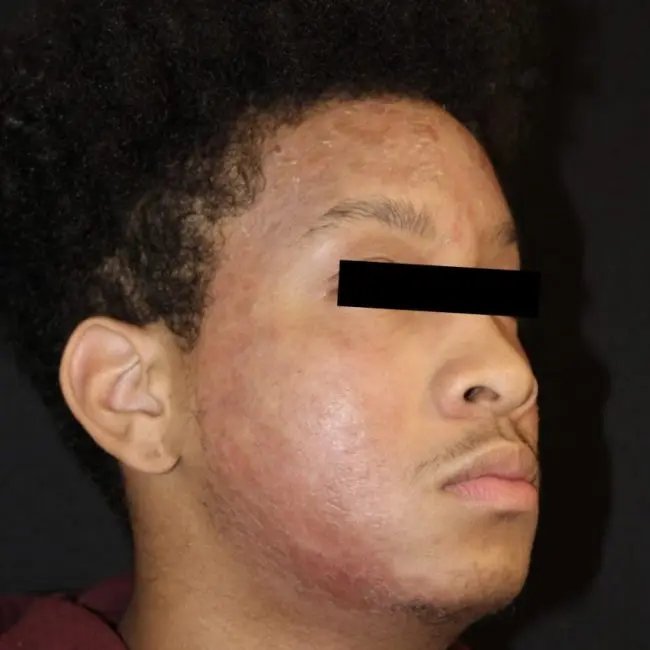 Celluma Light Therapy Before and After - Case -1, Image 1 - Male, age 25 – 34 - Baltimore, MD - Skin Therapeutics Med Spa