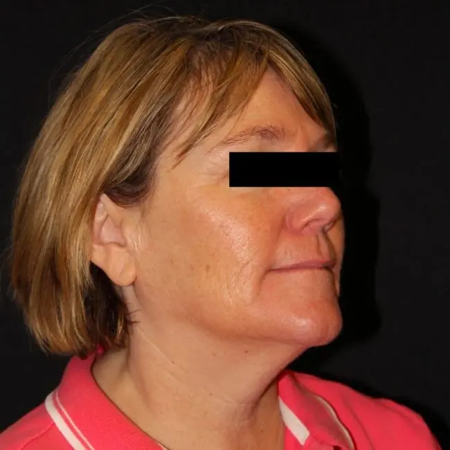 Microneedling Before and After - Case 2, Image 1 - Female, age 45 – 54 - Baltimore, MD - Skin Therapeutics Med Spa