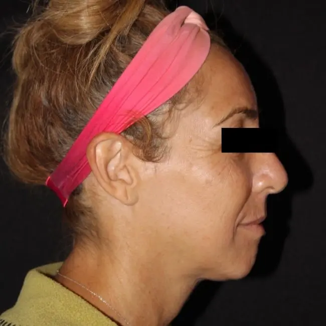 Facials & Peels Before and After - Case 2, Image 5 - Female, age 45 – 54 - Baltimore, MD - Skin Therapeutics Med Spa