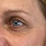 Before Fillers Under Eye