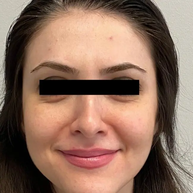 Botox Before and After - Case 3, Image 2 - Female, age 25 – 34 - Baltimore, MD - Skin Therapeutics Med Spa