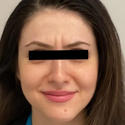 Botox Before and After - Case 3, Image 1 - Female, age 25 – 34 - Baltimore, MD - Skin Therapeutics Med Spa