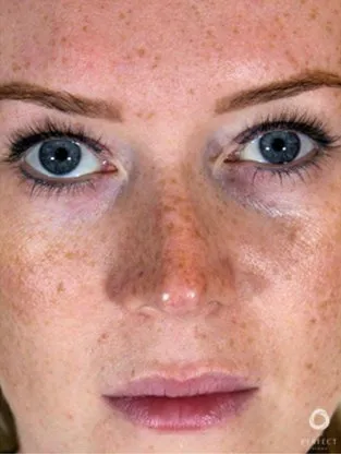 Facials & Peels Before and After - Case 6, Image 1 - Female, age 35 – 44 - Baltimore, MD - Skin Therapeutics Med Spa