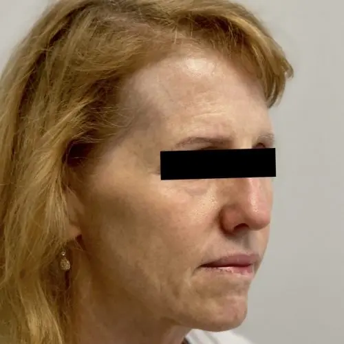 Fillers Before and After - Case 2, Image 3 - Female, age 45 – 54 - Baltimore, MD - Skin Therapeutics Med Spa