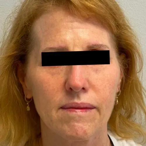 Fillers Before and After - Case 2, Image 1 - Female, age 45 – 54 - Baltimore, MD - Skin Therapeutics Med Spa