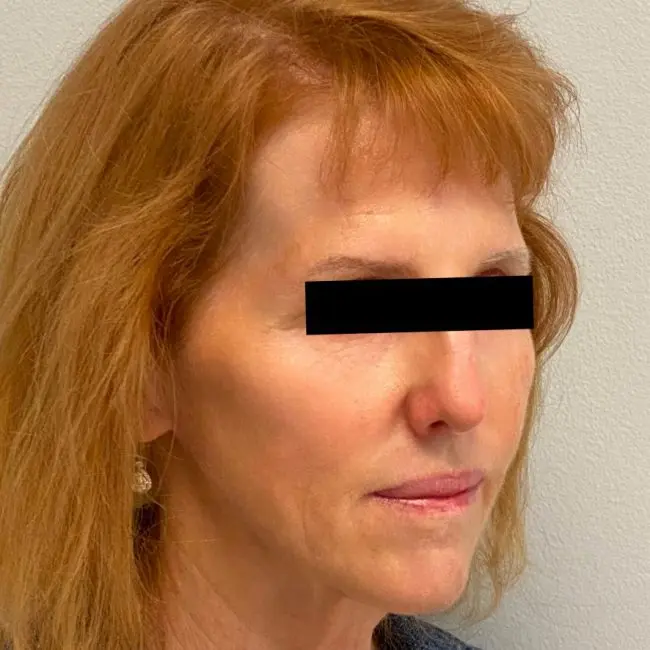 Fillers Before and After - Case 2, Image 4 - Female, age 45 – 54 - Baltimore, MD - Skin Therapeutics Med Spa