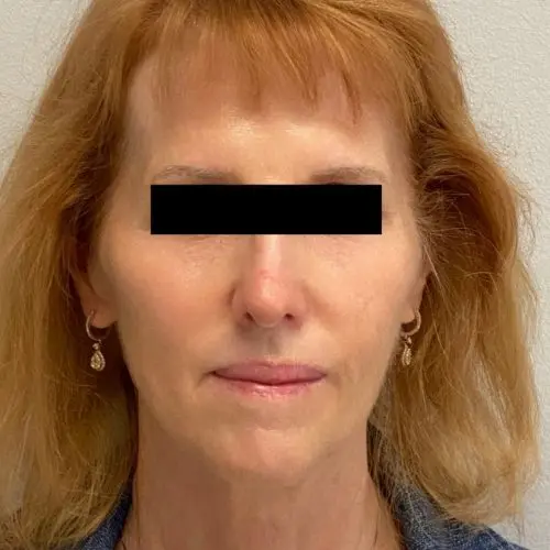 Fillers Before and After - Case 2, Image 2 - Female, age 45 – 54 - Baltimore, MD - Skin Therapeutics Med Spa