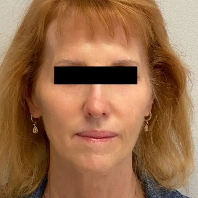 Fillers Before and After - Case 2, Image 2 - Female, age 45 – 54 - Baltimore, MD - Skin Therapeutics Med Spa