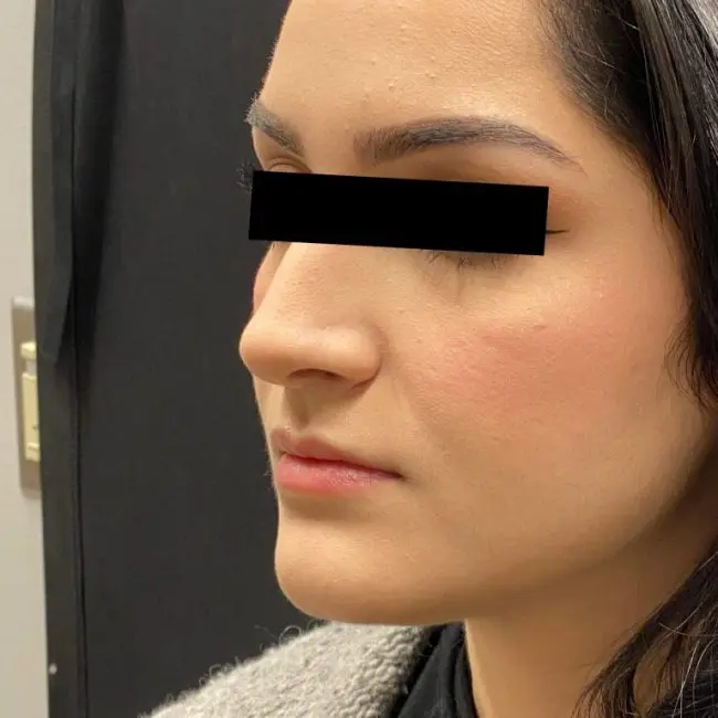 Fillers Before and After - Case 4, Image 1 - Female, age 25 – 34 - Baltimore, MD - Skin Therapeutics Med Spa