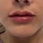 Filler Lips After