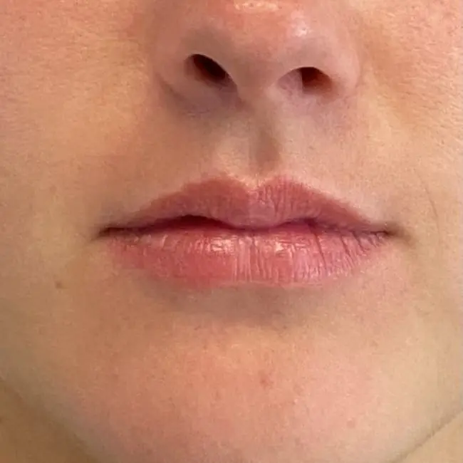 Fillers Before and After - Case -1, Image 1 - Female, age 18 – 24 - Baltimore, MD - Skin Therapeutics Med Spa