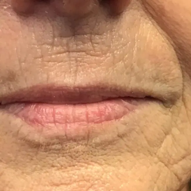 PDO Threads Before and After - Case -1, Image 2 - Female, age 65+ - Baltimore, MD - Skin Therapeutics Med Spa