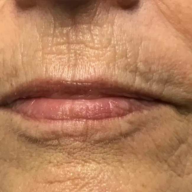 PDO Threads Before and After - Case -1, Image 1 - Female, age 65+ - Baltimore, MD - Skin Therapeutics Med Spa