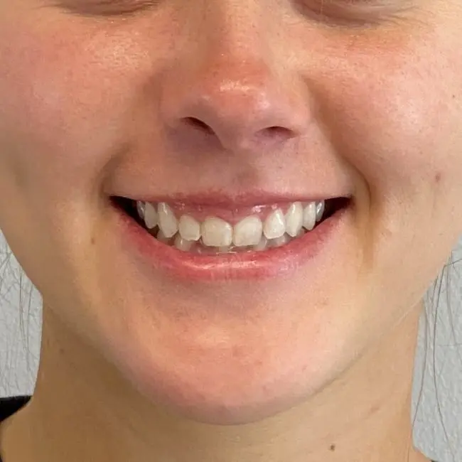 Botox Before and After - Case 2, Image 1 - Female, age 18 – 24 - Baltimore, MD - Skin Therapeutics Med Spa