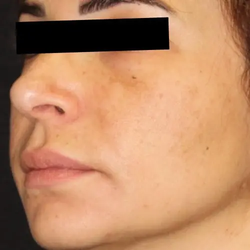 Facials & Peels Before and After - Case 3, Image 4 - Female, age 25 – 34 - Baltimore, MD - Skin Therapeutics Med Spa