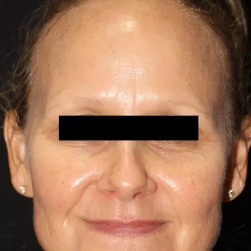 Facials & Peels Before and After - Case 4, Image 2 - Female, age 55 – 64 - Baltimore, MD - Skin Therapeutics Med Spa