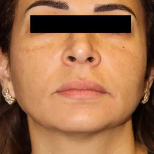 Facials & Peels Before and After - Case 3, Image 2 - Female, age 25 – 34 - Baltimore, MD - Skin Therapeutics Med Spa