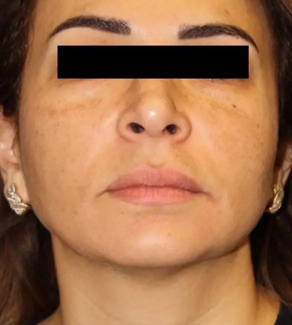 Facials & Peels Before and After - Case 3, Image 2 - Female, age 25 – 34 - Baltimore, MD - Skin Therapeutics Med Spa