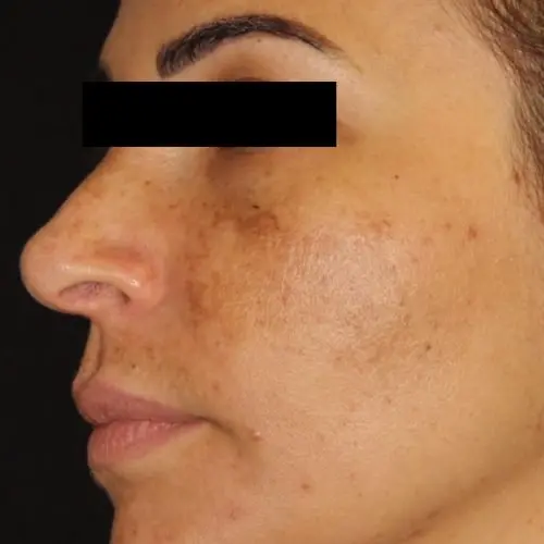 Facials & Peels Before and After - Case 3, Image 3 - Female, age 25 – 34 - Baltimore, MD - Skin Therapeutics Med Spa