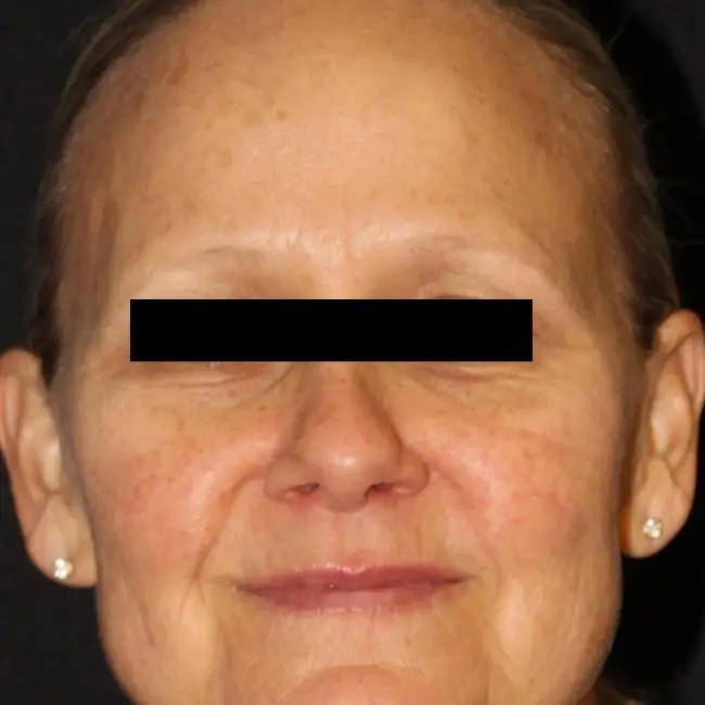 Facials & Peels Before and After - Case 4, Image 1 - Female, age 55 – 64 - Baltimore, MD - Skin Therapeutics Med Spa