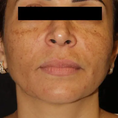 Facials & Peels Before and After - Case 3, Image 1 - Female, age 25 – 34 - Baltimore, MD - Skin Therapeutics Med Spa