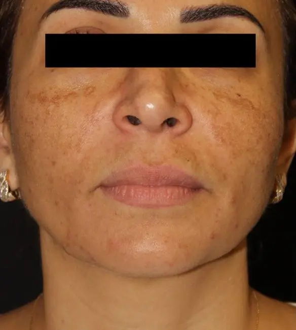 Facials & Peels Before and After - Case 3, Image 1 - Female, age 25 – 34 - Baltimore, MD - Skin Therapeutics Med Spa