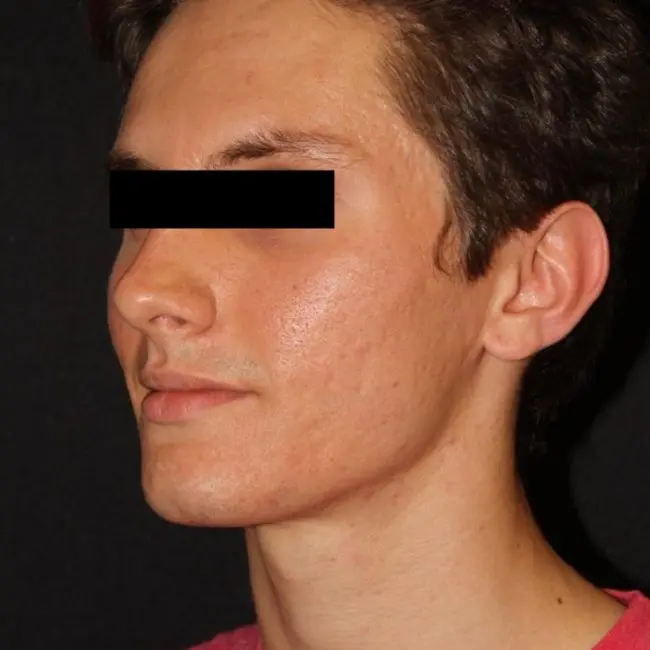 Microneedling Before and After - Case -1, Image 2 - Male, age 18 – 24 - Baltimore, MD - Skin Therapeutics Med Spa