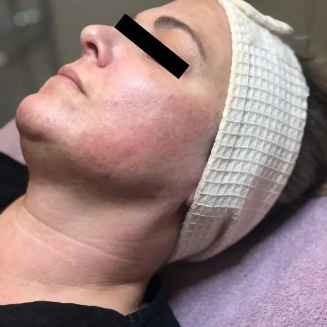 Dermaplaning Before and After - Case -1, Image 2 - Female, age  - Baltimore, MD - Skin Therapeutics Med Spa