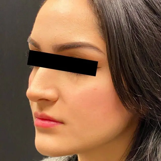 Fillers Before and After - Case 4, Image 2 - Female, age 25 – 34 - Baltimore, MD - Skin Therapeutics Med Spa