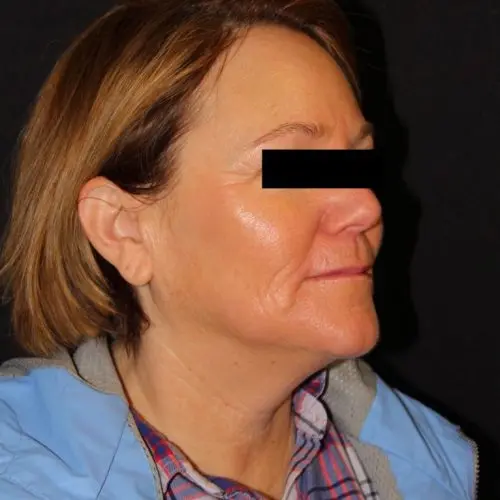 Microneedling Before and After - Case 2, Image 2 - Female, age 45 – 54 - Baltimore, MD - Skin Therapeutics Med Spa