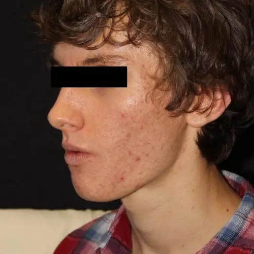 Microneedling Before and After - Case -1, Image 1 - Male, age 18 – 24 - Baltimore, MD - Skin Therapeutics Med Spa