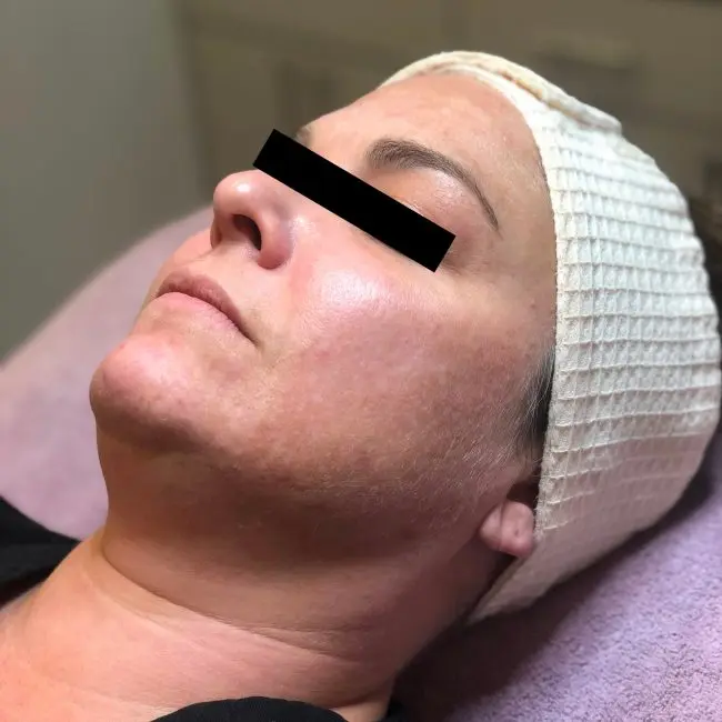 Dermaplaning Before and After - Case -1, Image 1 - Female, age  - Baltimore, MD - Skin Therapeutics Med Spa