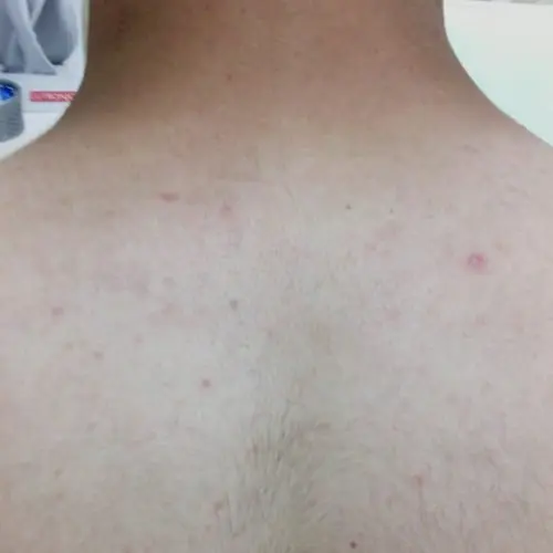 Clarity II Before and After - Case 3, Image 2 - Male, age  - Baltimore, MD - Skin Therapeutics Med Spa