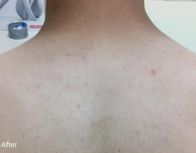 Clarity II Before and After - Case 3, Image 2 - Male, age  - Baltimore, MD - Skin Therapeutics Med Spa