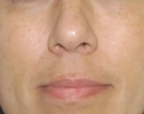 Clarity II Before and After - Case 2, Image 2 - Female, age  - Baltimore, MD - Skin Therapeutics Med Spa