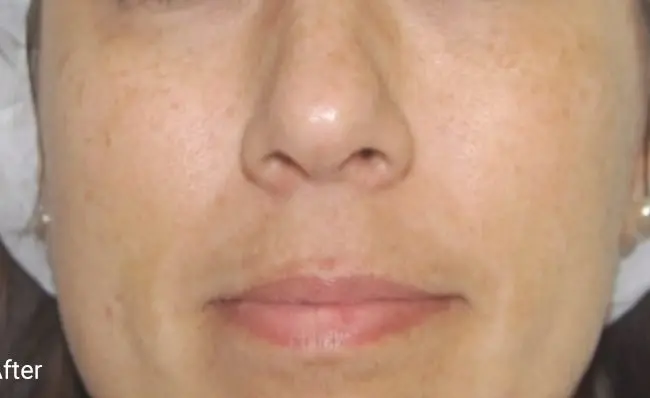 Clarity II Before and After - Case 2, Image 2 - Female, age  - Baltimore, MD - Skin Therapeutics Med Spa