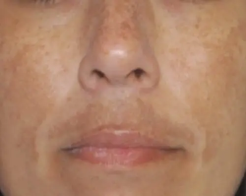 Clarity II Before and After - Case 2, Image 1 - Female, age  - Baltimore, MD - Skin Therapeutics Med Spa